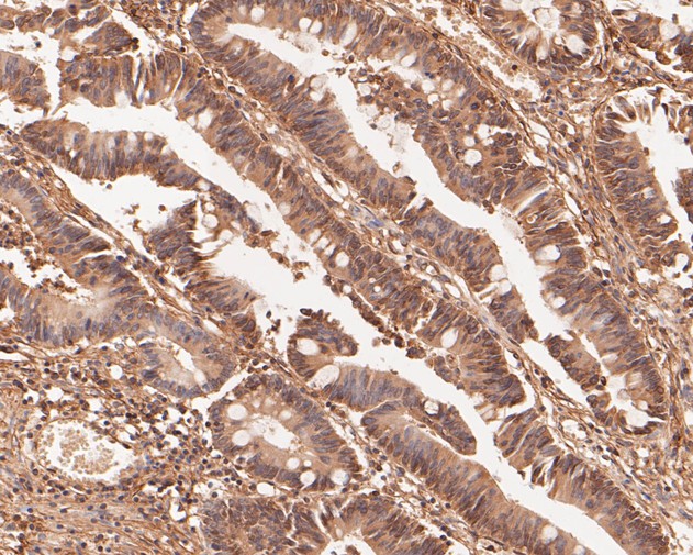 Immunohistochemical analysis of paraffin-embedded human colon carcinoma tissue using anti-TMX4 antibody. The section was pre-treated using heat mediated antigen retrieval with Tris-EDTA buffer (pH 8.0-8.4) for 20 minutes.The tissues were blocked in 5% BSA for 30 minutes at room temperature, washed with ddH2O and PBS, and then probed with the primary antibody (ER1902-31, 1/50) for 30 minutes at room temperature. The detection was performed using an HRP conjugated compact polymer system. DAB was used as the chromogen. Tissues were counterstained with hematoxylin and mounted with DPX.