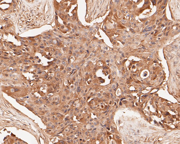 Immunohistochemical analysis of paraffin-embedded human breast carcinoma tissue using anti-TMX4 antibody. The section was pre-treated using heat mediated antigen retrieval with Tris-EDTA buffer (pH 8.0-8.4) for 20 minutes.The tissues were blocked in 5% BSA for 30 minutes at room temperature, washed with ddH2O and PBS, and then probed with the primary antibody (ER1902-31, 1/50) for 30 minutes at room temperature. The detection was performed using an HRP conjugated compact polymer system. DAB was used as the chromogen. Tissues were counterstained with hematoxylin and mounted with DPX.