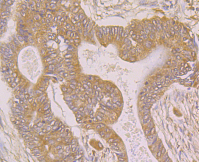 Immunohistochemical analysis of paraffin-embedded human colon cancer tissue using anti-SPATA13 antibody. The section was pre-treated using heat mediated antigen retrieval with Tris-EDTA buffer (pH 8.0-8.4) for 20 minutes.The tissues were blocked in 5% BSA for 30 minutes at room temperature, washed with ddH2O and PBS, and then probed with the primary antibody (ER1902-32, 1/50) for 30 minutes at room temperature. The detection was performed using an HRP conjugated compact polymer system. DAB was used as the chromogen. Tissues were counterstained with hematoxylin and mounted with DPX.