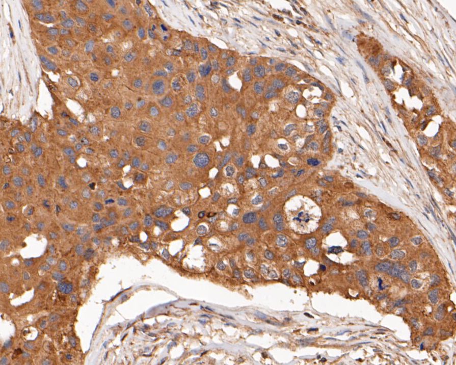 Immunohistochemical analysis of paraffin-embedded human breast carcinoma tissue using anti-PTEN antibody. The section was pre-treated using heat mediated antigen retrieval with sodium citrate buffer (pH 6.0) for 20 minutes. The tissues were blocked in 5% BSA for 30 minutes at room temperature, washed with ddH2O and PBS, and then probed with the primary antibody (ER1902-33, 1/50)  for 30 minutes at room temperature. The detection was performed using an HRP conjugated compact polymer system. DAB was used as the chromogen. Tissues were counterstained with hematoxylin and mounted with DPX.