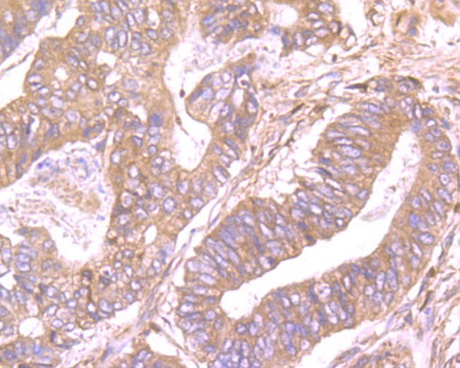 Immunohistochemical analysis of paraffin-embedded  Human colon cancer tissue using anti-SDF1 alpha antibody. The section was pre-treated using heat mediated antigen retrieval with Tris-EDTA buffer (pH 8.0-8.4) for 20 minutes.The tissues were blocked in 5% BSA for 30 minutes at room temperature, washed with ddH2O and PBS, and then probed with the primary antibody (ER1902-35, 1/100) for 30 minutes at room temperature. The detection was performed using an HRP conjugated compact polymer system. DAB was used as the chromogen. Tissues were counterstained with hematoxylin and mounted with DPX.