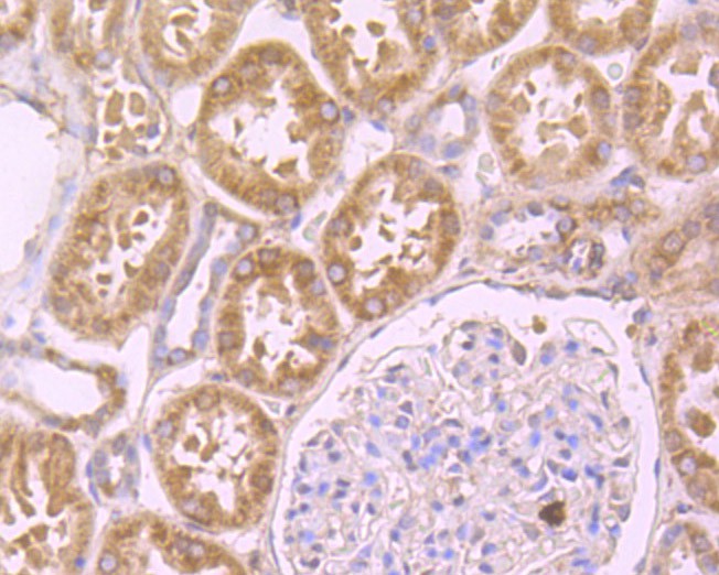 Immunohistochemical analysis of paraffin-embedded  Human colon cancer tissue using anti-SDF1 alpha antibody. The section was pre-treated using heat mediated antigen retrieval with Tris-EDTA buffer (pH 8.0-8.4) for 20 minutes.The tissues were blocked in 5% BSA for 30 minutes at room temperature, washed with ddH2O and PBS, and then probed with the primary antibody (ER1902-35, 1/100) for 30 minutes at room temperature. The detection was performed using an HRP conjugated compact polymer system. DAB was used as the chromogen. Tissues were counterstained with hematoxylin and mounted with DPX.
