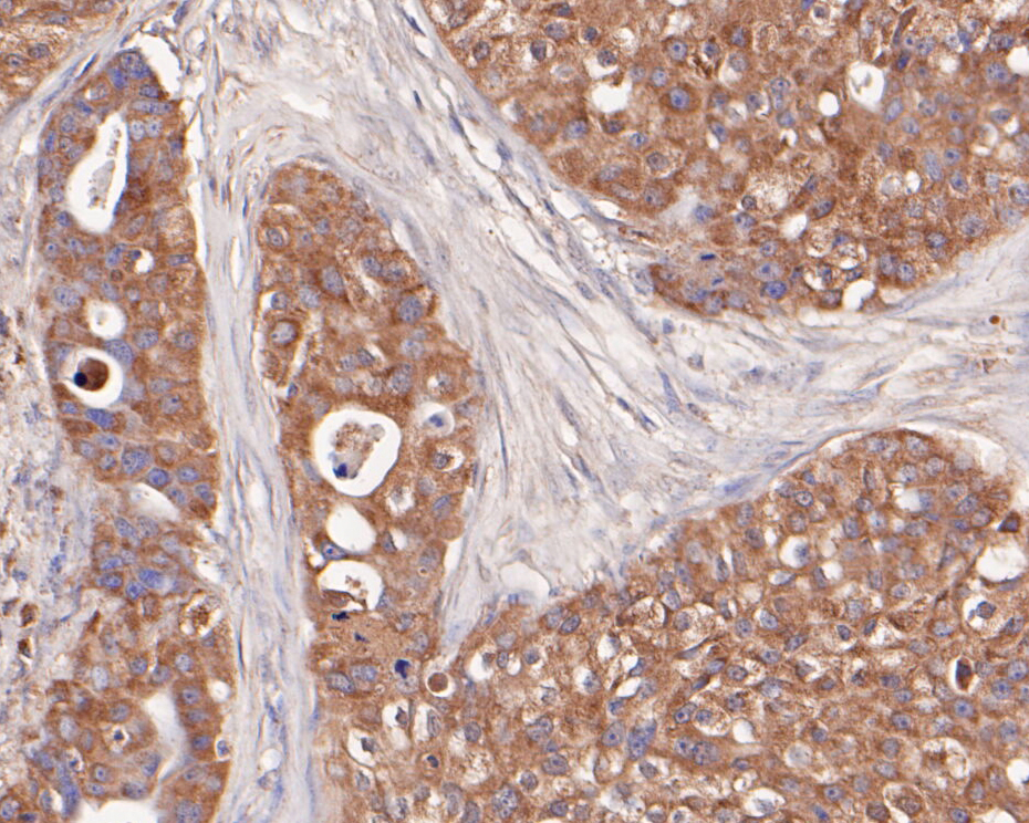 Immunohistochemical analysis of paraffin-embedded human breast carcinoma tissue using anti-ETN1 antibody. The section was pre-treated using heat mediated antigen retrieval with Tris-EDTA buffer (pH 8.0-8.4) for 20 minutes.The tissues were blocked in 5% BSA for 30 minutes at room temperature, washed with ddH2O and PBS, and then probed with the primary antibody (ER1902-43, 1/50) for 30 minutes at room temperature. The detection was performed using an HRP conjugated compact polymer system. DAB was used as the chromogen. Tissues were counterstained with hematoxylin and mounted with DPX.