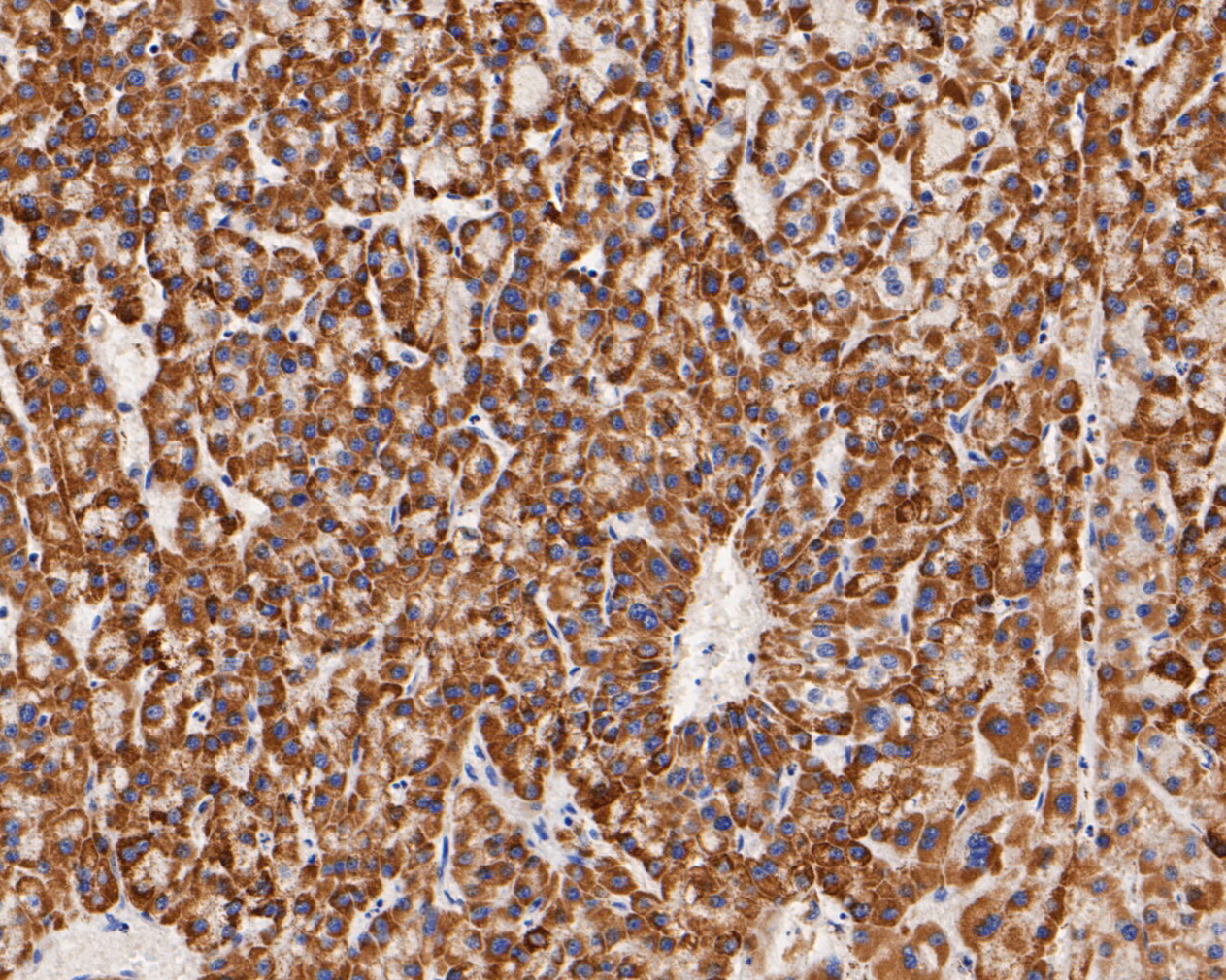 Immunohistochemical analysis of paraffin-embedded human liver carcinoma tissue using anti-KCNK9 antibody. The section was pre-treated using heat mediated antigen retrieval with Tris-EDTA buffer (pH 8.0-8.4) for 20 minutes.The tissues were blocked in 5% BSA for 30 minutes at room temperature, washed with ddH2O and PBS, and then probed with the primary antibody (ER1902-47, 1/200) for 30 minutes at room temperature. The detection was performed using an HRP conjugated compact polymer system. DAB was used as the chromogen. Tissues were counterstained with hematoxylin and mounted with DPX.