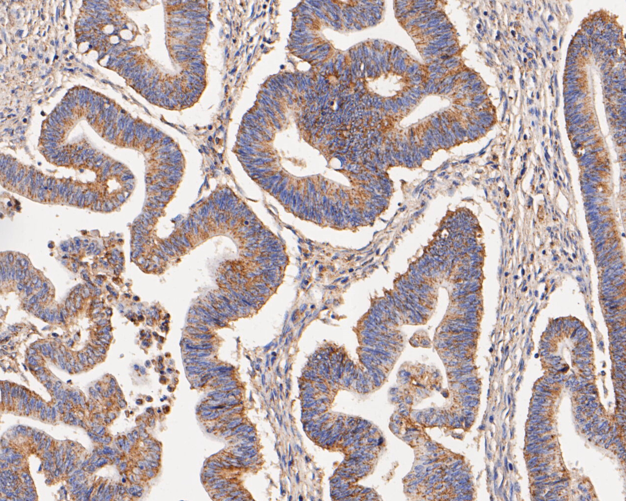Immunohistochemical analysis of paraffin-embedded human colon carcinoma tissue using anti-KCNK9 antibody. The section was pre-treated using heat mediated antigen retrieval with Tris-EDTA buffer (pH 8.0-8.4) for 20 minutes.The tissues were blocked in 5% BSA for 30 minutes at room temperature, washed with ddH2O and PBS, and then probed with the primary antibody (ER1902-47, 1/50) for 30 minutes at room temperature. The detection was performed using an HRP conjugated compact polymer system. DAB was used as the chromogen. Tissues were counterstained with hematoxylin and mounted with DPX.