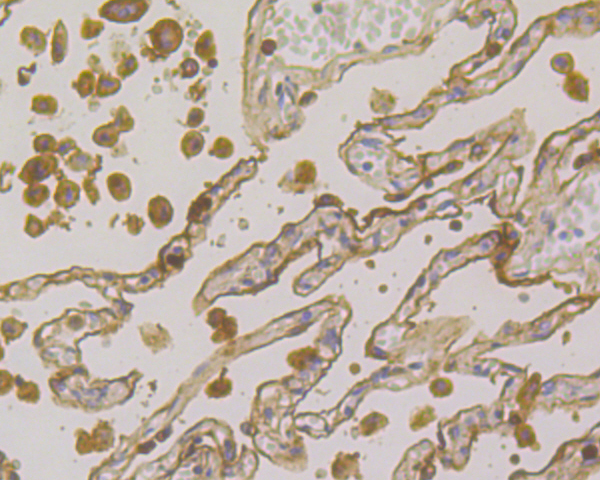 Immunohistochemical analysis of paraffin-embedded human lung cancer tissue using anti-CEACAM6 antibody. The section was pre-treated using heat mediated antigen retrieval with Tris-EDTA buffer (pH 8.0-8.4) for 20 minutes.The tissues were blocked in 5% BSA for 30 minutes at room temperature, washed with ddH2O and PBS, and then probed with the primary antibody (ER1902-54, 1/100) for 30 minutes at room temperature. The detection was performed using an HRP conjugated compact polymer system. DAB was used as the chromogen. Tissues were counterstained with hematoxylin and mounted with DPX.