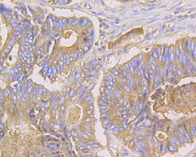 Immunohistochemical analysis of paraffin-embedded human colon cancer tissue using anti-CEACAM6 antibody. The section was pre-treated using heat mediated antigen retrieval with Tris-EDTA buffer (pH 8.0-8.4) for 20 minutes.The tissues were blocked in 5% BSA for 30 minutes at room temperature, washed with ddH2O and PBS, and then probed with the primary antibody (ER1902-54, 1/100) for 30 minutes at room temperature. The detection was performed using an HRP conjugated compact polymer system. DAB was used as the chromogen. Tissues were counterstained with hematoxylin and mounted with DPX.