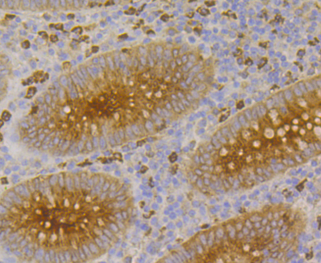 Immunohistochemical analysis of paraffin-embedded human appendix cancer tissue using anti-CEACAM6 antibody. The section was pre-treated using heat mediated antigen retrieval with Tris-EDTA buffer (pH 8.0-8.4) for 20 minutes.The tissues were blocked in 5% BSA for 30 minutes at room temperature, washed with ddH2O and PBS, and then probed with the primary antibody (ER1902-54, 1/100) for 30 minutes at room temperature. The detection was performed using an HRP conjugated compact polymer system. DAB was used as the chromogen. Tissues were counterstained with hematoxylin and mounted with DPX.