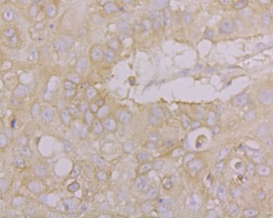 Immunohistochemical analysis of paraffin-embedded human lung cancer tissue using anti-Drebrin antibody. The section was pre-treated using heat mediated antigen retrieval with Tris-EDTA buffer (pH 8.0-8.4) for 20 minutes.The tissues were blocked in 5% BSA for 30 minutes at room temperature, washed with ddH2O and PBS, and then probed with the primary antibody (ER1902-55, 1/200) for 30 minutes at room temperature. The detection was performed using an HRP conjugated compact polymer system. DAB was used as the chromogen. Tissues were counterstained with hematoxylin and mounted with DPX.