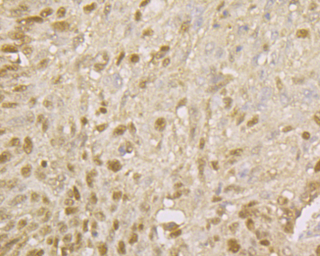 Immunohistochemical analysis of paraffin-embedded human  lung cancer tissue using anti-MCM7 antibody. The section was pre-treated using heat mediated antigen retrieval with sodium citrate buffer (pH 6.0) for 20 minutes. The tissues were blocked in 5% BSA for 30 minutes at room temperature, washed with ddH2O and PBS, and then probed with the primary antibody (ER1902-60, 1/50)  for 30 minutes at room temperature. The detection was performed using an HRP conjugated compact polymer system. DAB was used as the chromogen. Tissues were counterstained with hematoxylin and mounted with DPX.