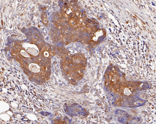 Immunohistochemical analysis of paraffin-embedded human breast carcinoma tissue using anti-DNMT3A antibody. The section was pre-treated using heat mediated antigen retrieval with sodium citrate buffer (pH 6.0) for 20 minutes. The tissues were blocked in 5% BSA for 30 minutes at room temperature, washed with ddH2O and PBS, and then probed with the primary antibody (ER1902-62, 1/200)  for 30 minutes at room temperature. The detection was performed using an HRP conjugated compact polymer system. DAB was used as the chromogen. Tissues were counterstained with hematoxylin and mounted with DPX.