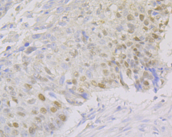 Immunohistochemical analysis of paraffin-embedded human lung cancer tissue using anti-FEN1 antibody. The section was pre-treated using heat mediated antigen retrieval with sodium citrate buffer (pH 6.0) for 20 minutes. The tissues were blocked in 5% BSA for 30 minutes at room temperature, washed with ddH2O and PBS, and then probed with the primary antibody (ER1902-64, 1/100)  for 30 minutes at room temperature. The detection was performed using an HRP conjugated compact polymer system. DAB was used as the chromogen. Tissues were counterstained with hematoxylin and mounted with DPX.