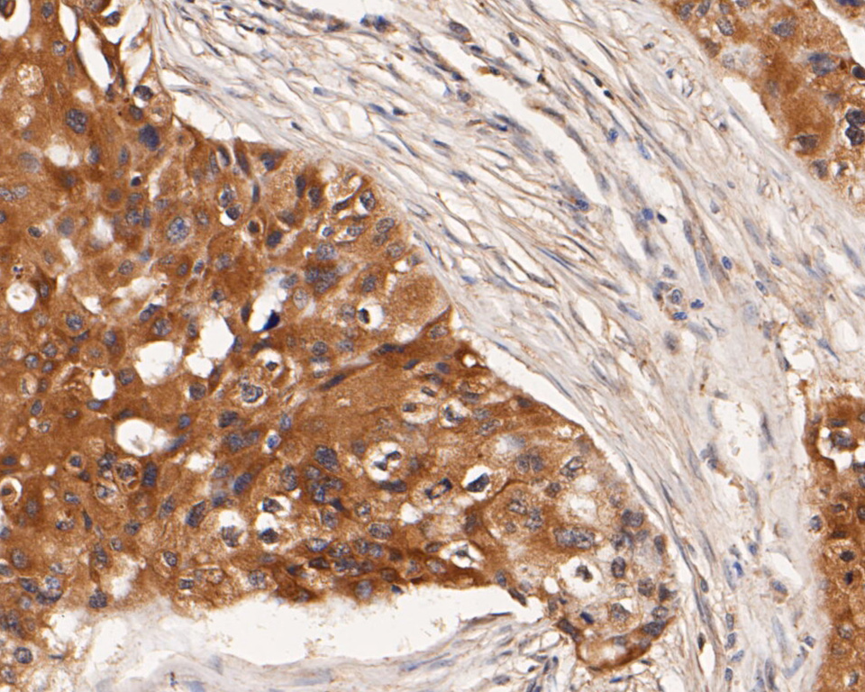 Immunohistochemical analysis of paraffin-embedded human breast cancer tissue using anti-Kidins220 antibody. The section was pre-treated using heat mediated antigen retrieval with Tris-EDTA buffer (pH 8.0-8.4) for 20 minutes.The tissues were blocked in 5% BSA for 30 minutes at room temperature, washed with ddH2O and PBS, and then probed with the primary antibody (ER1902-65, 1/50) for 30 minutes at room temperature. The detection was performed using an HRP conjugated compact polymer system. DAB was used as the chromogen. Tissues were counterstained with hematoxylin and mounted with DPX.