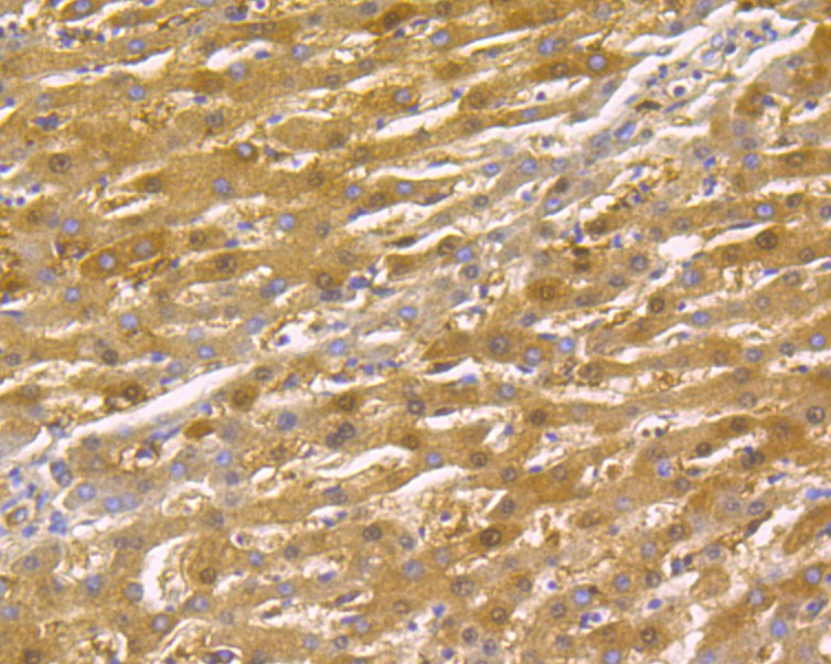 Immunohistochemical analysis of paraffin-embedded human liver cancer tissue using anti-Thymidine Phosphorylase antibody. The section was pre-treated using heat mediated antigen retrieval with Tris-EDTA buffer (pH 8.0-8.4) for 20 minutes.The tissues were blocked in 5% BSA for 30 minutes at room temperature, washed with ddH2O and PBS, and then probed with the primary antibody (ER1902-79, 1/200) for 30 minutes at room temperature. The detection was performed using an HRP conjugated compact polymer system. DAB was used as the chromogen. Tissues were counterstained with hematoxylin and mounted with DPX.