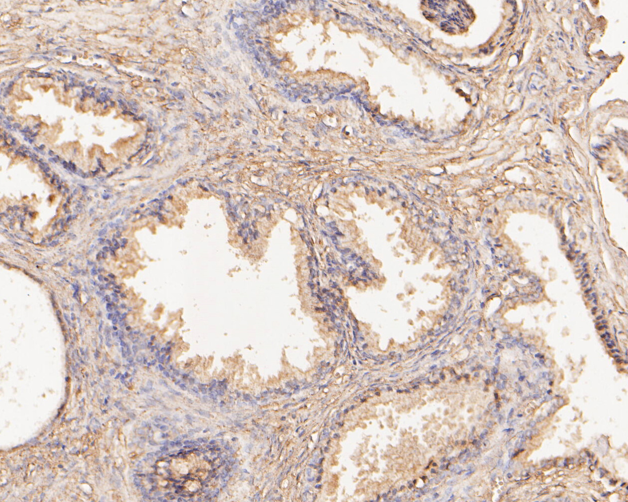 Immunohistochemical analysis of paraffin-embedded human prostate tissue using anti-SLFN12 antibody. The section was pre-treated using heat mediated antigen retrieval with Tris-EDTA buffer (pH 8.0-8.4) for 20 minutes.The tissues were blocked in 5% BSA for 30 minutes at room temperature, washed with ddH2O and PBS, and then probed with the primary antibody (ER1902-84, 1/50) for 30 minutes at room temperature. The detection was performed using an HRP conjugated compact polymer system. DAB was used as the chromogen. Tissues were counterstained with hematoxylin and mounted with DPX.