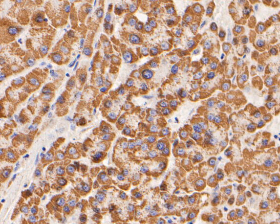 Immunohistochemical analysis of paraffin-embedded human liver carcinoma tissue using anti-GLUD1 antibody. The section was pre-treated using heat mediated antigen retrieval with Tris-EDTA buffer (pH 8.0-8.4) for 20 minutes.The tissues were blocked in 5% BSA for 30 minutes at room temperature, washed with ddH2O and PBS, and then probed with the primary antibody (ER1902-85, 1/200) for 30 minutes at room temperature. The detection was performed using an HRP conjugated compact polymer system. DAB was used as the chromogen. Tissues were counterstained with hematoxylin and mounted with DPX.