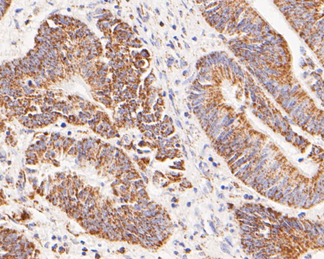 Immunohistochemical analysis of paraffin-embedded human colon carcinoma tissue using anti-GLUD1 antibody. The section was pre-treated using heat mediated antigen retrieval with Tris-EDTA buffer (pH 8.0-8.4) for 20 minutes.The tissues were blocked in 5% BSA for 30 minutes at room temperature, washed with ddH2O and PBS, and then probed with the primary antibody (ER1902-85, 1/200) for 30 minutes at room temperature. The detection was performed using an HRP conjugated compact polymer system. DAB was used as the chromogen. Tissues were counterstained with hematoxylin and mounted with DPX.