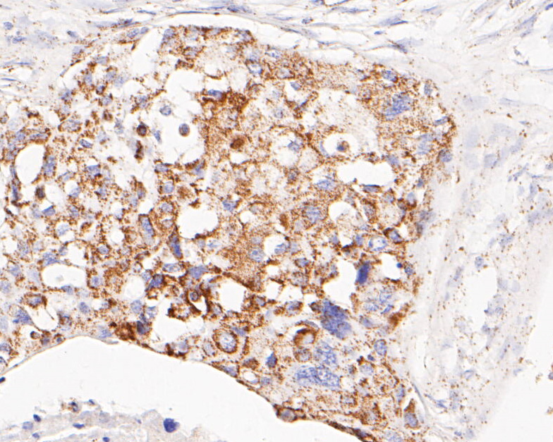 Immunohistochemical analysis of paraffin-embedded human breast carcinoma tissue using anti-GLUD1 antibody. The section was pre-treated using heat mediated antigen retrieval with Tris-EDTA buffer (pH 8.0-8.4) for 20 minutes.The tissues were blocked in 5% BSA for 30 minutes at room temperature, washed with ddH2O and PBS, and then probed with the primary antibody (ER1902-85, 1/200) for 30 minutes at room temperature. The detection was performed using an HRP conjugated compact polymer system. DAB was used as the chromogen. Tissues were counterstained with hematoxylin and mounted with DPX.