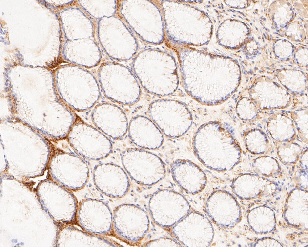 Immunohistochemical analysis of paraffin-embedded human stomach carcinoma tissue using anti-Claudin18.2 antibody. The section was pre-treated using heat mediated antigen retrieval with Tris-EDTA buffer (pH 8.0-8.4) for 20 minutes.The tissues were blocked in 5% BSA for 30 minutes at room temperature, washed with ddH2O and PBS, and then probed with the primary antibody (ER1902-86, 1/400) for 30 minutes at room temperature. The detection was performed using an HRP conjugated compact polymer system. DAB was used as the chromogen. Tissues were counterstained with hematoxylin and mounted with DPX.