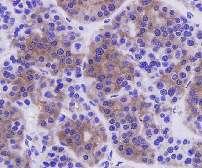 Immunohistochemical analysis of paraffin-embedded human liver carcinoma tissue using anti-Caspase-3 antibody. Counter stained with hematoxylin.