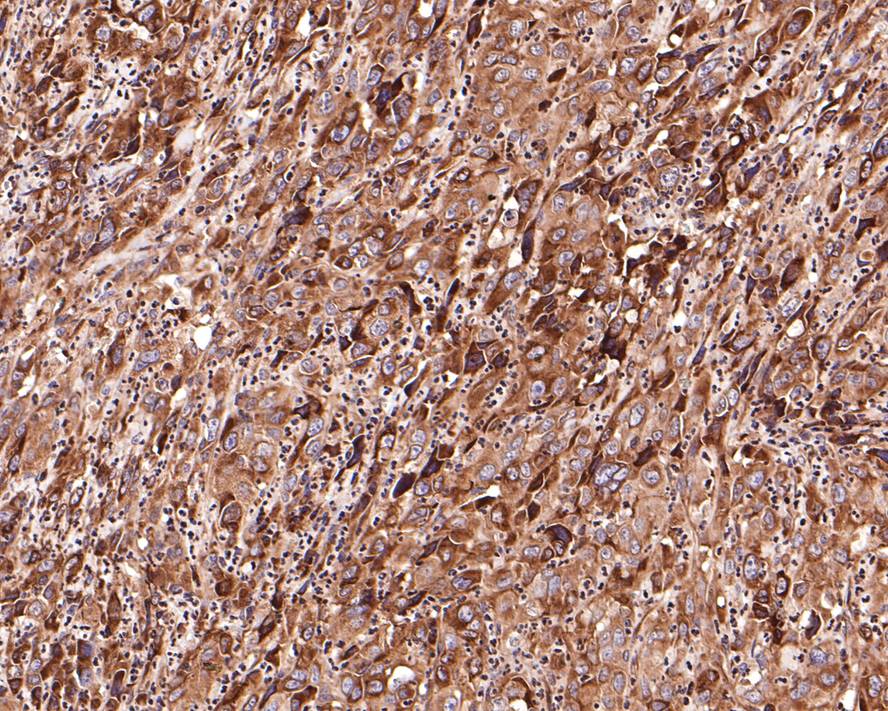 Immunohistochemical analysis of paraffin-embedded human liver carcinoma tissue with Rabbit anti-Integrin beta 1 antibody (ER31001) at 1/1,000 dilution.<br />
<br />
The section was pre-treated using heat mediated antigen retrieval with Tris-EDTA buffer (pH 9.0) for 20 minutes. The tissues were blocked in 1% BSA for 20 minutes at room temperature, washed with ddH2O and PBS, and then probed with the primary antibody (ER31001) at 1/1,000 dilution for 1 hour at room temperature. The detection was performed using an HRP conjugated compact polymer system. DAB was used as the chromogen. Tissues were counterstained with hematoxylin and mounted with DPX.