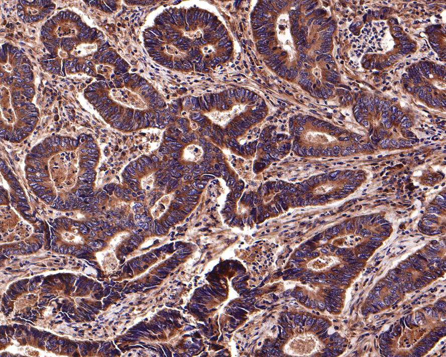 Immunohistochemical analysis of paraffin-embedded human colon carcinoma tissue with Rabbit anti-Integrin beta 1 antibody (ER31001) at 1/1,000 dilution.<br />
<br />
The section was pre-treated using heat mediated antigen retrieval with Tris-EDTA buffer (pH 9.0) for 20 minutes. The tissues were blocked in 1% BSA for 20 minutes at room temperature, washed with ddH2O and PBS, and then probed with the primary antibody (ER31001) at 1/1,000 dilution for 1 hour at room temperature. The detection was performed using an HRP conjugated compact polymer system. DAB was used as the chromogen. Tissues were counterstained with hematoxylin and mounted with DPX.
