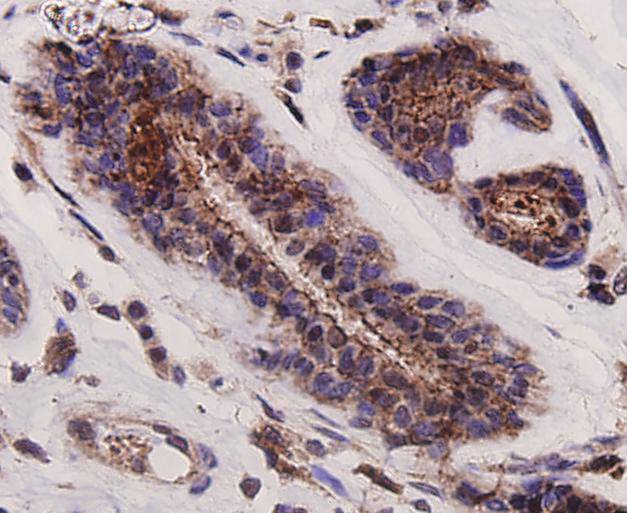 Immunohistochemical analysis of paraffin-embedded human breast cancer tissue using anti-GRB2 antibody. Counter stained with hematoxylin.