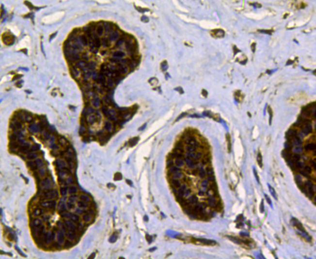 Immunohistochemical analysis of paraffin-e.mbedded human breast cancer tissue using anti-CDk1 antibody. Counter stained with hematoxylin