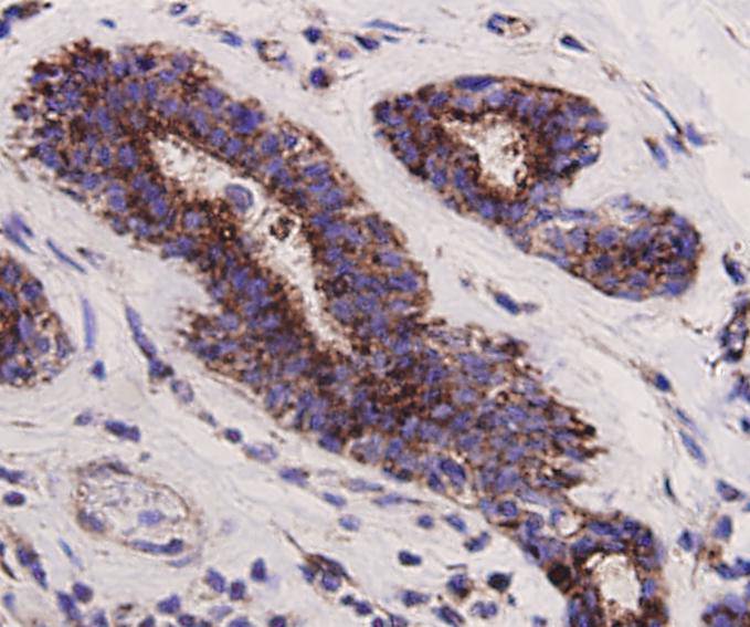 Immunohistochemical analysis of paraffin-embedded human breast carcinoma tissue using anti-PUMA antibody. Counter stained with hematoxylin.