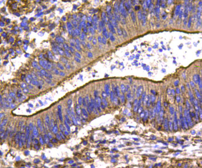Immunohistochemical analysis of paraffin-embedded human colon carcinoma tissue using anti-Hsp27 antibody. Counter stained with hematoxylin.