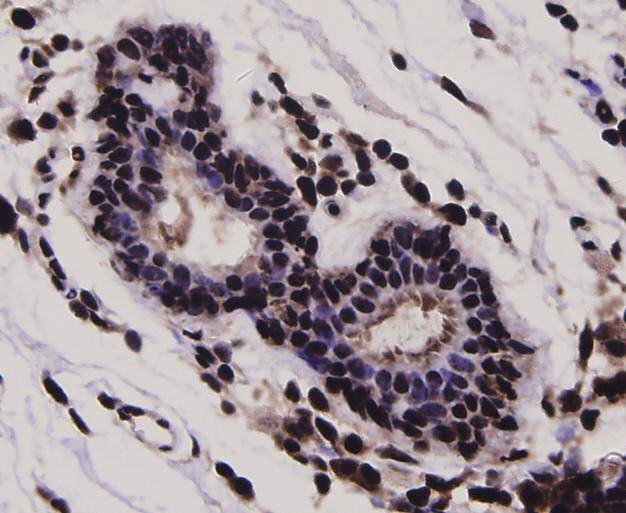 Immunohistochemical analysis of paraffin-embedded human breast cancer tissue using anti-Stat-1α/β antibody. Counter stained with hematoxylin.