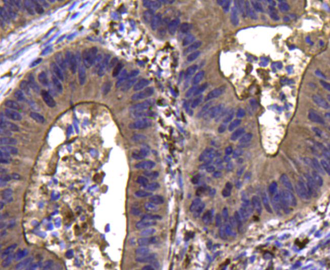 Immunohistochemical analysis of paraffin-embedded human colon cancer tissue using anti-CDK6 antibody. Counter stained with hematoxylin.