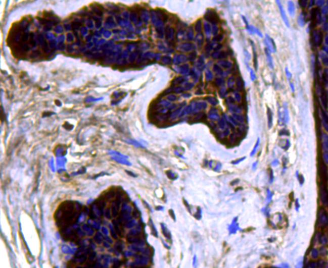 Immunohistochemical analysis of paraffin-embedded human breast cancer tissue using anti-CDK6 antibody. Counter stained with hematoxylin.