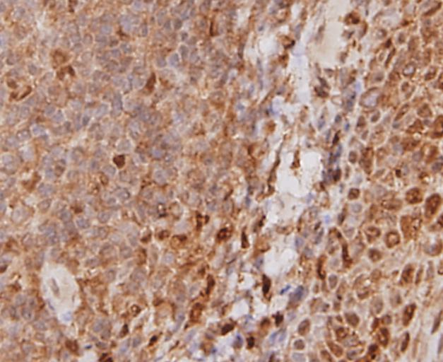 Immunohistochemical analysis of paraffin-embedded human kidney tissue using anti-STAT6 antibody. Counter stained with hematoxylin.