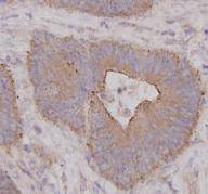 Immunohistochemical analysis of paraffin-embedded human colon cancer tissue using anti-ROCK1 antibody. Counter stained with hematoxylin.