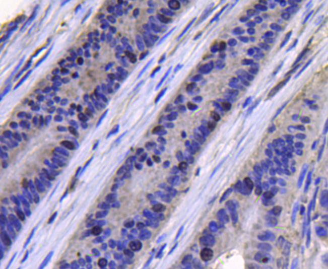 Immunohistochemical analysis of paraffin-embedded human colon cancer tissue using anti-TOP2A antibody. Counter stained with hematoxylin.