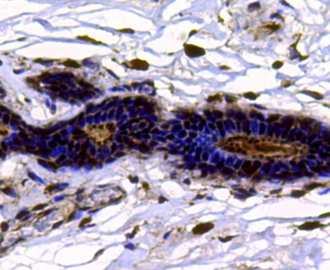 Immunohistochemical analysis of paraffin-embedded human colon cancer tissue using anti-TOP2A antibody. Counter stained with hematoxylin.