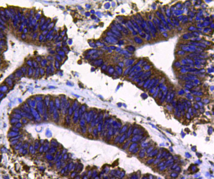 Immunohistochemical analysis of paraffin-embedded human colon carcinoma tissue using anti-PDI antibody. Counter stained with hematoxylin.