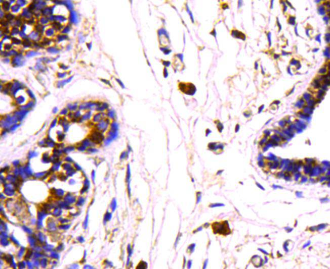 Immunohistochemical analysis of paraffin-embedded human breast cancer tissue using anti-HSP70 antibody. Counter stained with hematoxylin.