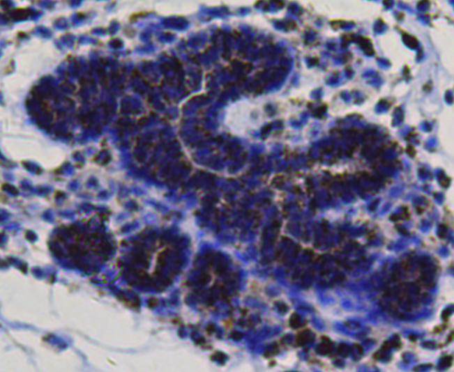 Immunohistochemical analysis of paraffin-embedded human breast cancer tissue using anti-BMP2 antibody. Counter stained with hematoxylin.