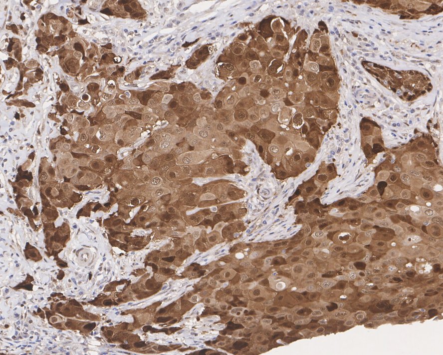 ICC staining of Hsp70 in MCF-7 cells (green). Formalin fixed cells were permeabilized with 0.1% Triton X-100 in TBS for 10 minutes at room temperature and blocked with 1% Blocker BSA for 15 minutes at room temperature. Cells were probed with the primary antibody (ET1601-11, 1/50) for 1 hour at room temperature, washed with PBS. Alexa Fluor®488 Goat anti-Rabbit IgG was used as the secondary antibody at 1/1,000 dilution. The nuclear counter stain is DAPI (blue).