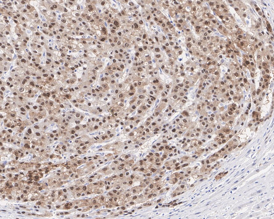 Immunohistochemical analysis of paraffin-embedded human breast carcinoma tissue using anti-Hsp70 antibody. The section was pre-treated using heat mediated antigen retrieval with sodium citrate buffer (pH 6.0) for 20 minutes. The tissues were blocked in 5% BSA for 30 minutes at room temperature, washed with ddH2O and PBS, and then probed with the primary antibody (ET1601-11, 1/50)  for 30 minutes at room temperature. The detection was performed using an HRP conjugated compact polymer system. DAB was used as the chromogen. Tissues were counterstained with hematoxylin and mounted with DPX.