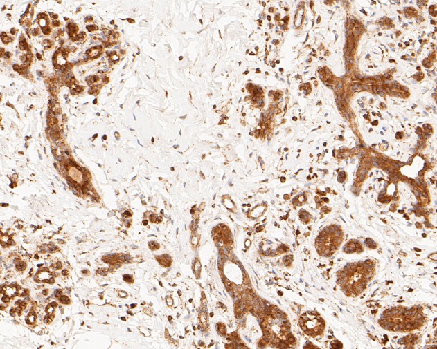Immunohistochemical analysis of paraffin-embedded human breast tissue using anti-Hsp70 antibody. The section was pre-treated using heat mediated antigen retrieval with sodium citrate buffer (pH 6.0) for 20 minutes. The tissues were blocked in 5% BSA for 30 minutes at room temperature, washed with ddH2O and PBS, and then probed with the primary antibody (ET1601-11, 1/50)  for 30 minutes at room temperature. The detection was performed using an HRP conjugated compact polymer system. DAB was used as the chromogen. Tissues were counterstained with hematoxylin and mounted with DPX.