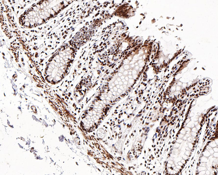 Immunohistochemical analysis of paraffin-embedded human colon tissue with Rabbit anti-Histone H3(mono methyl K18) antibody (ET1601-14) at 1/1,000 dilution.<br />
<br />
The section was pre-treated using heat mediated antigen retrieval with sodium citrate buffer (pH 6.0) for 2 minutes. The tissues were blocked in 1% BSA for 20 minutes at room temperature, washed with ddH2O and PBS, and then probed with the primary antibody (ET1601-14) at 1/1,000 dilution for 1 hour at room temperature. The detection was performed using an HRP conjugated compact polymer system. DAB was used as the chromogen. Tissues were counterstained with hematoxylin and mounted with DPX.