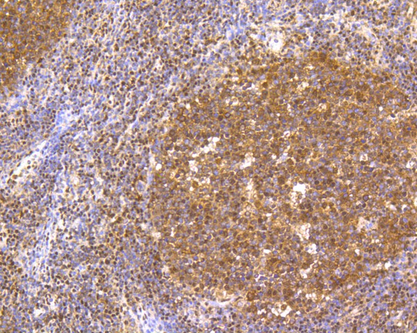 Immunohistochemical analysis of paraffin-embedded human lung carcinoma tissue using anti-CREB antibody. The section was pre-treated using heat mediated antigen retrieval with Tris-EDTA buffer (pH 8.0-8.4) for 20 minutes.The tissues were blocked in 5% BSA for 30 minutes at room temperature, washed with ddH2O and PBS, and then probed with the primary antibody (ET1601-15, 1/200) for 30 minutes at room temperature. The detection was performed using an HRP conjugated compact polymer system. DAB was used as the chromogen. Tissues were counterstained with hematoxylin and mounted with DPX.