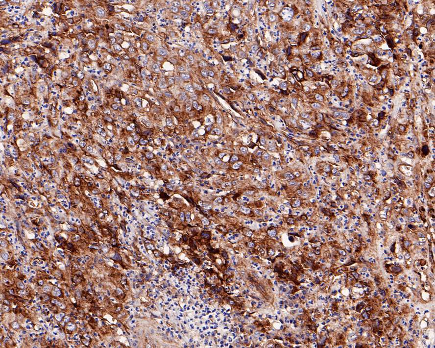 Immunohistochemical analysis of paraffin-embedded human liver  carcinoma tissue with Rabbit anti-Integrin beta 1 antibody (ET1601-17) at 1/500 dilution.<br />
<br />
The section was pre-treated using heat mediated antigen retrieval with Tris-EDTA buffer (pH 9.0) for 20 minutes. The tissues were blocked in 1% BSA for 20 minutes at room temperature, washed with ddH2O and PBS, and then probed with the primary antibody (ET1601-17) at 1/500 dilution for 1 hour at room temperature. The detection was performed using an HRP conjugated compact polymer system. DAB was used as the chromogen. Tissues were counterstained with hematoxylin and mounted with DPX.