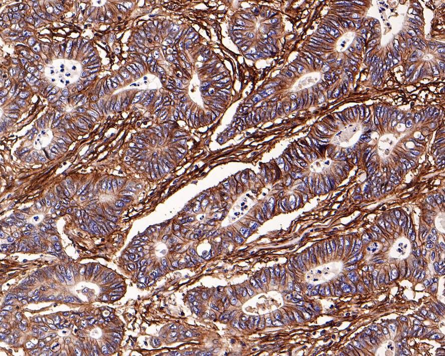 Immunohistochemical analysis of paraffin-embedded human colon carcinoma tissue using anti-Integrin beta 1 antibody. The section was pre-treated using heat mediated antigen retrieval with Tris-EDTA buffer (pH 9.0) for 20 minutes.The tissues were blocked in 5% BSA for 30 minutes at room temperature, washed with ddH2O and PBS, and then probed with the primary antibody (ET1601-17, 1/200) for 30 minutes at room temperature. The detection was performed using an HRP conjugated compact polymer system. DAB was used as the chromogen. Tissues were counterstained with hematoxylin and mounted with DPX.