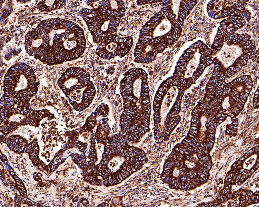 Immunohistochemical analysis of paraffin-embedded human colon carcinoma tissue with Rabbit anti-PBR antibody (ET1601-19) at 1/400 dilution.<br />
<br />
The section was pre-treated using heat mediated antigen retrieval with Tris-EDTA buffer (pH 9.0) for 20 minutes. The tissues were blocked in 1% BSA for 20 minutes at room temperature, washed with ddH2O and PBS, and then probed with the primary antibody (ET1601-19) at 1/400 dilution for 1 hour at room temperature. The detection was performed using an HRP conjugated compact polymer system. DAB was used as the chromogen. Tissues were counterstained with hematoxylin and mounted with DPX.