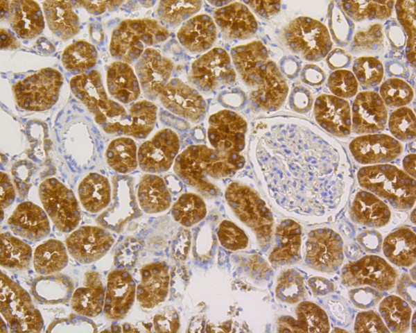 Immunohistochemical analysis of paraffin-embedded human liver carcinoma tissue using anti-Alkaline Phosphatase antibody. The section was pre-treated using heat mediated antigen retrieval with Tris-EDTA buffer (9.0) for 20 minutes.The tissues were blocked in 5% BSA for 30 minutes at room temperature, washed with ddH2O and PBS, and then probed with the primary antibody (ET1601-21, 1/50) for 30 minutes at room temperature. The detection was performed using an HRP conjugated compact polymer system. DAB was used as the chromogen. Tissues were counterstained with hematoxylin and mounted with DPX.