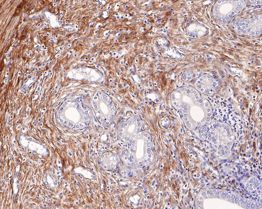 Immunohistochemical analysis of paraffin-embedded human endometrium tissue with Rabbit anti-p75 NGF Receptor antibody (ET1601-22) at 1/500 dilution.<br />
<br />
The section was pre-treated using heat mediated antigen retrieval with Tris-EDTA buffer (pH 9.0) for 20 minutes. The tissues were blocked in 1% BSA for 20 minutes at room temperature, washed with ddH2O and PBS, and then probed with the primary antibody (ET1601-22) at 1/500 dilution for 1 hour at room temperature. The detection was performed using an HRP conjugated compact polymer system. DAB was used as the chromogen. Tissues were counterstained with hematoxylin and mounted with DPX.